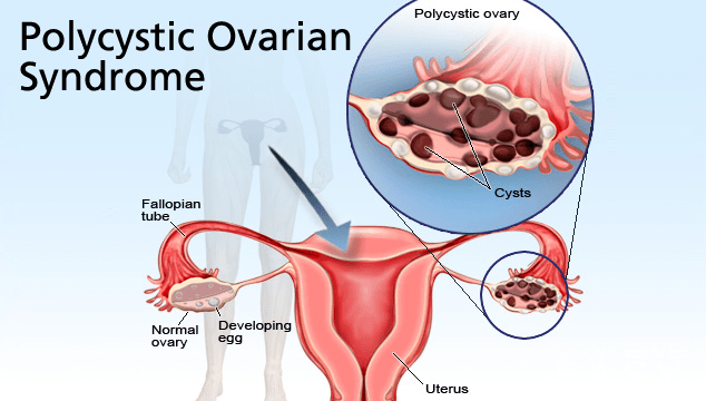 polycystic ovarian syndrome, infertility, ocala news, having a baby, parenting, children, adoption Ocala couple faces the pain of infertility