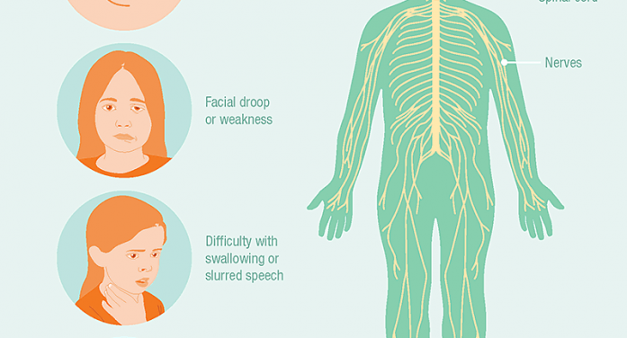 Acute flaccid myelitis (AFM), health, dcd, ocala post, ocala news 90 confirmed cases of Acute flaccid myelitis (AFM)