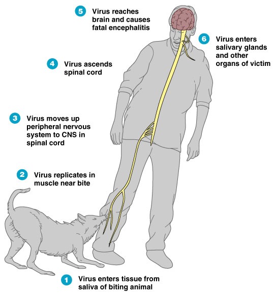 Rabies in humans