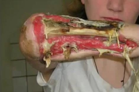 Devastating drug named Krokodil surfaces in U.S. cities