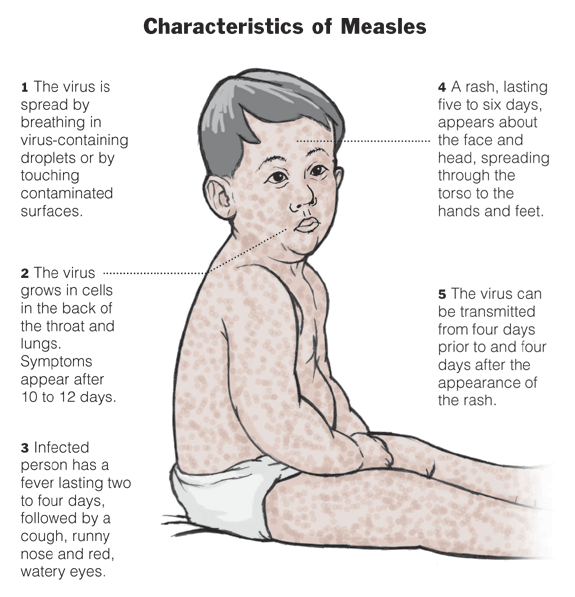 Measles outbreak in the U.S.